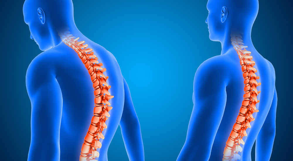 3D medical background showing correct and poor posture with spin 3D render of a medical background showing correct and poor posture with spine highlighted